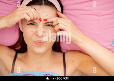 Itching and burning acne chickenpox on face of young beautiful woman. Hands comb sores from virus Stock Photo