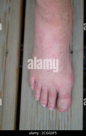 wasp sting swollen toe