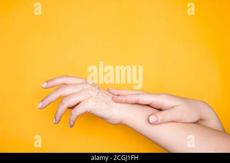 Hands with dry cracked skin, the concept of hand skin problems. Yellow background Stock Photo