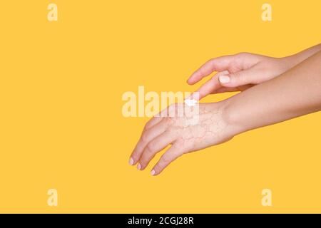 Hand care, soft skin. Hands with chapped dry skin and moisturizer. Free space for text. Stock Photo