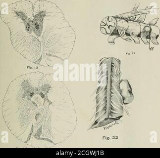 . International record of medicine . Fig. 12 Sections from various cords, iinintentionallv liniiscil at tlic autopsy, fouml in tllaboratory collection of .spinal cords. Plate III. Plate VII.. -- v.  V ^:r ■m i&lt;A Stock Photo