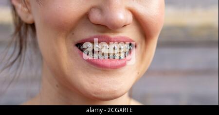 brasket system in smiling mouth, macro photo teeth, close-up lips, macro shot. Stock Photo