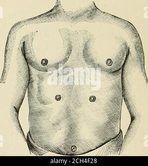 Accessory nipple on a woman's breast Stock Photo - Alamy