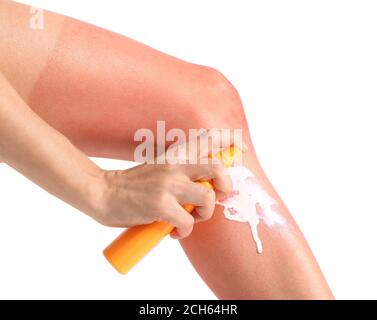 Woman with red sunburned skin applying cream against white background Stock Photo