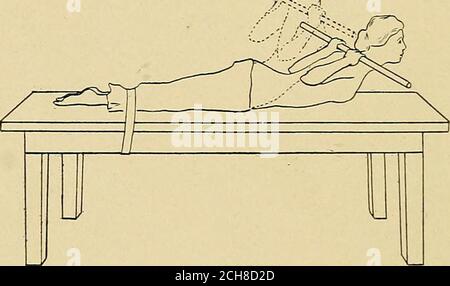 . Lateral curvature of the spine and round shoulders . Fig. 93.. Fig. 94. VIII. Trunk Raising with Dumb-bells and Staff.—These are merely varietiesof Exercise VII, in which the position of the shoulders is modified by means ofdumb-bells or wands held in the hands, or in which the center of gravity is changedby the dumb-bells, making the exercise harder, (a) The patient grasping dumb-bells, places them together against the back and as high up as possible, (b) Thepatient grasping the dumb-bells with the arms extended above the head, circum-ducts the arms during the two counts of the exercise, (c Stock Photo