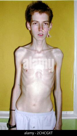 anorexic guys