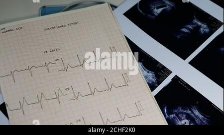 Ultrasound scan report and Electrocardiogram reading Stock Photo