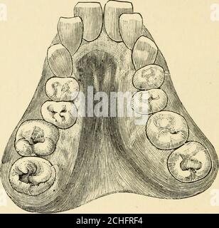 . The teeth in health and disease . Fin. 15.—An irregularity caused by thumb sucking. The V-shaped,. contracted dental arch isquite amenable to treatment and is generallyexpanded by the use of a plate fitting thepalate with or without covering the teeth.The plate is sawn in half and a spring isintroduced, in such a manner that it has aconstant tendency to force the two halvesapart. Disproportion in size of the upper andlower jaws is of frequent occurrence. Theupper teeth are often very short and much toofar outside the lower ones so that the frontteeth actually rest on the lower lip, completel Stock Photo