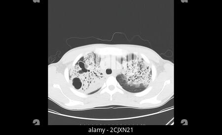 Axial computed Tomography of the chest (lung window) in a known patient of Active Tuberculosis (TB) showing pneumonia and cavitation in both lungs Stock Photo