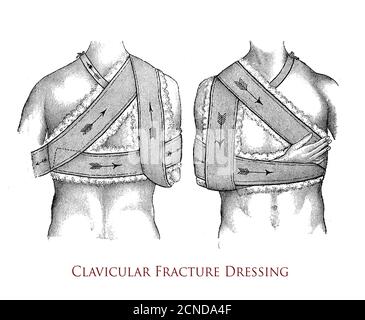 Healthcare and medicine: drawing explaining how to perform a clavicular fracture dressing, vintage illustration Stock Photo