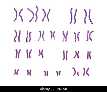 Karyotype of Angelman syndrome (AS), computer illustration. AS is a genetic disorder characterised by arm flapping, excessive laughing (even when hurt Stock Photo