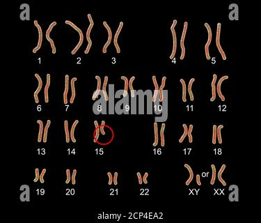 Karyotype of Prader-Willi syndrome, computer illustration. This is a genetic disorder caused by the deletion of a region on chromosome 15 inherited fr Stock Photo