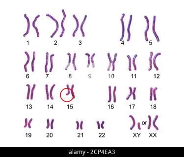 Karyotype of Angelman syndrome (AS), computer illustration. AS is a genetic disorder characterised by arm flapping, excessive laughing (even when hurt Stock Photo