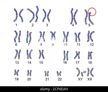 Karyotype of a patient with cri du chat syndrome (also known as Cat cry syndrome), computer illustration. Cri du chat syndrome is a group on syndromes Stock Photo