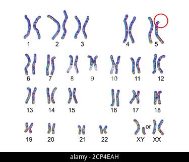 Karyotype of a patient with cri du chat syndrome (also known as Cat cry ...