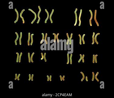 Karyotype of Angelman syndrome (AS), computer illustration. AS is a genetic disorder characterised by arm flapping, excessive laughing (even when hurt Stock Photo