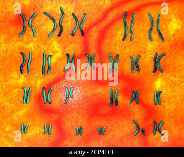 Karyotype of Prader-Willi syndrome, computer illustration. This is a genetic disorder caused by the deletion of a region on chromosome 15 inherited fr Stock Photo