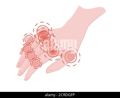 Human pain in the fingers with red pain circle flat vector illustration on white background Stock Vector