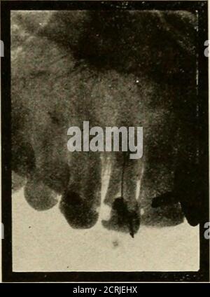 . Elementary and dental radiography / by Howard Riley Raper . Fig. 183 Fig. 184 Fig. 183. Wire just penetrating the apical foramen. Showing that the apical sensitiveness is not due to an unremoved, undevitalized remnant of pulpal tissue. Fig. 184. The wire in the canal of the lateral fails to reach the apex, proving that the apical sensitiveness is due to an unremoved, undevitalized remnant of pulpal tissue. 1$. Co Eearn if Apical Sensitiveness Ts Due to a Large Apical foramen or anUnrcmoocd, Undevitalized Remnant of Pulp. In the treatment of teeth we often pass theTiflS. 1*3 and l$4. broach i Stock Photo