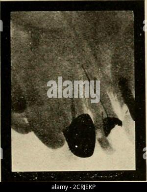 . Elementary and dental radiography / by Howard Riley Raper . ld test, andwe suspect that the canals are poorly filled, or perhaps not filled at all.Are we justified in removing the crown or filling to examine the canals?Before the radiograph came into use we were, but not to-day. It is notfair to your patient nor yourself to remove a canal filling unless you canimprove on the operation. Fig. 182 is a radiograph of a case of the THE USES OF THE RADIOGRAPH IN DENTISTRY 183 class just alluded to. The canal filling in the shell crowned lower, firstmolar is so imperfect, it should not be difficult Stock Photo