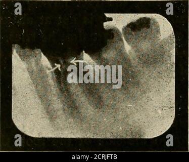 . Elementary and dental radiography . Fig. 175. The upper arrow points ...