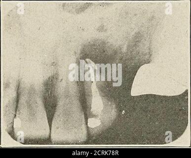 . Interpretation of dental and maxillary roentgenograms . Fig. 48. Fig. 49. Fig. 48.—Upper right lateral incisor shows post for support of crown, no otherroot filling; ill-defined dark area abovit apex due to chronic rarefying osteitis withsuppuration. Nasal fossa with inferior turbinate well shown above. Fig. 49.—Upper right lateral incisor contains devitalized pulp (faradic test) underfilling. Ill-defined dark area about apex due to chronic rarefying osteitis with sup-puration. 82 IlSrTERPKETATION OF ROENTGElsrOGRAMS Upper Anterior Region. Stock Photo