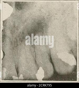 . Interpretation of dental and maxillary roentgenograms . Fig. 48. Fig. 49. Fig. 48.—Upper right lateral incisor shows post for support of crown, no otherroot filling; ill-defined dark area abovit apex due to chronic rarefying osteitis withsuppuration. Nasal fossa with inferior turbinate well shown above. Fig. 49.—Upper right lateral incisor contains devitalized pulp (faradic test) underfilling. Ill-defined dark area about apex due to chronic rarefying osteitis with sup-puration. 82 IlSrTERPKETATION OF ROENTGElsrOGRAMS Upper Anterior Region Stock Photo