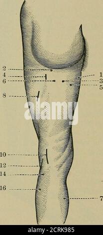 . A practical treatise on medical diagnosis for students and physicians . Motor points of the thigh, anterior surface. Motor points of the thigh, posterior surface. (From VON ZiEMssEX.) Fig. .56.-1. Tensor vaginae femoris (branch of the superior gluteal nerve). 2. Anterior cruralnerve. -3. Tensor vaginae femoris (branch of the crural nerve). 4. Obturator nerve. 5. Rectusfemoris. 6. Sartorius. 7. Vastus externus. 8. Adductor longus. 9. Vastus externus. 10. Branchof the crural nerve to the quadriceps extensor cruris. 12. Crureus. 14. Branch of the crural nerveto the vastus externus. Fig. .57.—1. Stock Photo