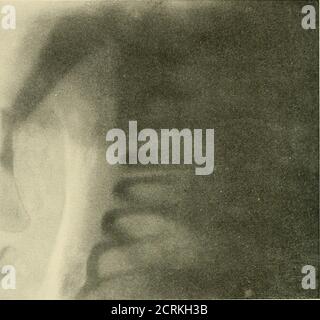 Child Rentgen Right humerus fracture, axial X-ray after accident Stock Photo - Alamy