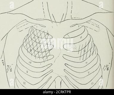 . The Roentgen rays in medicine and surgery as an aid in diagnosis and as a therapeutic agent; designed for the use of practitioners and students . Fig. 108. G. R. Second X-ray examination with screen. Patient improving. Excursion of dia-phragm 1.25 centimetres on right side; increased on left side. (One-third life size.) MarcJi 7. X-Ray Examination with Screc7i, as shown in cut oftracing made on this day (see Fig. 107). — The whole of the right chestwas dark ; no outlines seen ; the lower portion of the right chest ratherlighter than the upper portion, which indicated consolidation of thelung Stock Photo