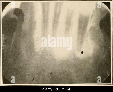 . Oral sepsis in its relationship to systemic disease . Fig. 75. Fig. 76. Stock Photo