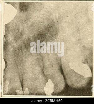 . Interpretation of dental & maxillary roentgenograms . Fig. 48. Fig. 49. Fig. 48.—Upper right lateral incisor shows post for support of crown, no otherroot filling; ill-defined dark area about apex due to chronic rarefying osteitis withsuppuration. Nasal fossa with inferior turbinate well shown above. Fig. 49.—Upper right lateral incisor contains devitalized pulp (faradic test) underfilling. Ill-defined dark area about apex due to chronic rarefying osteitis with sup-puration. 82 JXTKKIHKTATIOX OF ROENTGENOGRAMS Upper Anterior Region Stock Photo