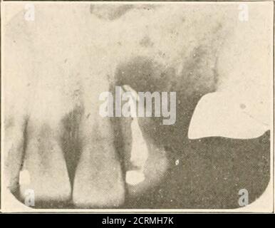 . Interpretation of dental & maxillary roentgenograms . Fig. 48. Fig. 49. Fig. 48.—Upper right lateral incisor shows post for support of crown, no otherroot filling; ill-defined dark area about apex due to chronic rarefying osteitis withsuppuration. Nasal fossa with inferior turbinate well shown above. Fig. 49.—Upper right lateral incisor contains devitalized pulp (faradic test) underfilling. Ill-defined dark area about apex due to chronic rarefying osteitis with sup-puration. 82 JXTKKIHKTATIOX OF ROENTGENOGRAMS Upper Anterior Region. Stock Photo