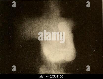 Hampton Line Stomach ulcer, barium X-ray Stock Photo - Alamy
