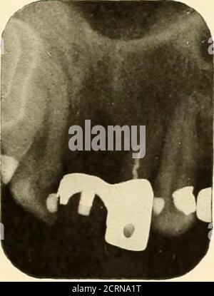 . Oral Roentgenology : a Roentgen study of the anatomy and pathology of the oral cavity . Figure 214.. Stock Photo