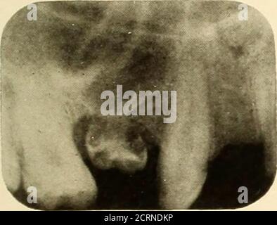 . Oral Roentgenology : a Roentgen study of the anatomy and pathology of the oral cavity . Figure 62.. Stock Photo