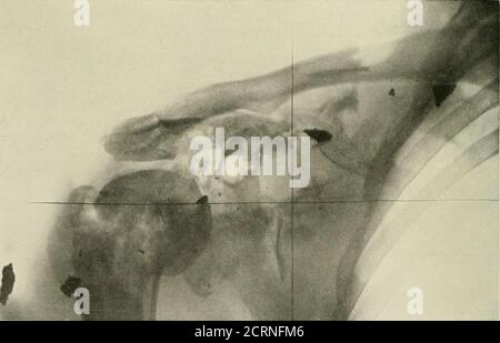 . Radiography and radio-therapeutics . PLATE XI.—Gas Gangrene. a, Extensive and diffuse infiltration of the calf without any bone damage. Foreign body present. b, Radiographed on the third day. An extensive gas infiltration seen behind the knee. The patient didwell after three incisions. c, Eadiograph four days after the wound was infected. Several discrete bubbles, together with a fair amountof diffuse infiltration. There is extensive bone damage, and the foreign body is seen in situ. (From radiograms by Dr. Martin Berry.) GAS IN THE TISSUES 193 may be invaluable to his country in an administ Stock Photo