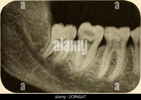 . Oral Roentgenology : a Roentgen study of the anatomy and pathology of the oral cavity . Figure i.. Stock Photo