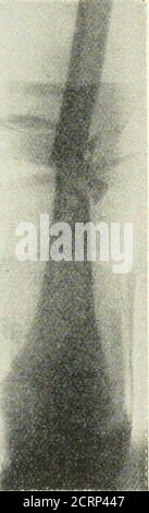 . Radiography, x-ray therapeutics and radium therapy . Fig. 140.—Fracture through shafts of both femora.The fracture is comminuted on the left side. Fractures of the Patella These may vary from mere fissures to complete fracture with wideseparation at the line of fractme. The partial fracture is the one which it ismost important to recognise. A lateral view of the knee-joint is the mostuseful position in which to radiograph the joint for its recognition. Fractures of the Bones of the Leg The tibia and fibula may be involved when there is a fracture of thelower end of the femur; they may be bro Stock Photo