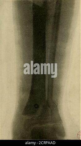 . The Roentgen rays in medicine and surgery as an aid in diagnosis and as a therapeutic agent : designed for the use of practitioners and students . Fig. 279. William A. Lateral view. HA wheel, and injured his right leg. There was apparently an oblique frac-ture of both bones of the leg. About ten days later two X-ray pictures. Fig. 280. John C, ten years old. Patient of Dr. W. P. Bolles. While coasting ran into curbing,injuring left leg. Two radiographs are given, which show a separation of the epiphysis at the lowerend of the tibia, and the fibrous fracture of the fibula. Antero-posterior vi Stock Photo