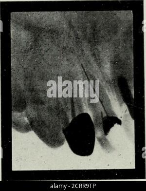 . Elementary and dental radiography . ned tooth, or a tooth witha large metal filling in it. The tooth fails to respond to the cold test, andwe suspect that the canals are poorly filled, or perhaps not filled at all.Are we justified in removing the crown or filling to examine the canals?Before the radiograph came into use we were, but not to-day. It is notfair to your patient nor yourself to remove a canal filling unless you canimprove on the operation. Fig. 182 is a radiograph of a case of the THE USES OE THE RADIOGRAPH IN DENTISTRY 183 class just alluded to. After the radiograph was made I h Stock Photo