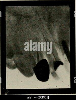 . Elementary and dental radiography . crowned tooth, or a tooth with a large metal lilling in it. The tooth fails to respond to the cold test, and lisped that the canals are poorly filled, or perhaps not filled at all.Are we justified in removing the crown or filling to examine the canals? re the radiograph came into use we were, but not to-day. It is notfair to your patient nor yourself to remove a canal filling unless you canimprove on tin- operation, fig. iSj i- a radiograph of a case of the THE USES OF THE RADIOGRAPH IX DENTISTRY 183 class just alluded to. After the radiograph was made I h Stock Photo