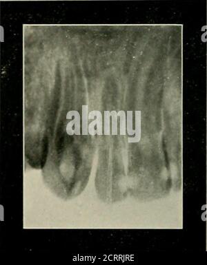 . Elementary and dental radiography . Fig. 150. Fig. 151. Fig. 150 ...