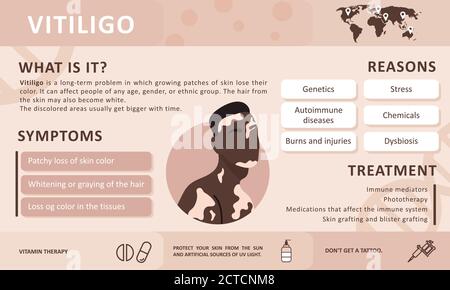 Infographics of vitiligo. Causes of the disease. Abstract african man silhouette. Vector concept to support people living with vitiligo and to build Stock Vector