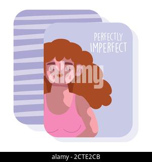 perfectly imperfect, cartoon woman curly hair and vitiligo disease vector illustration Stock Vector