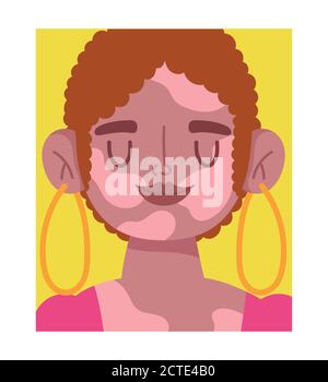 perfectly imperfect, cartoon woman face with vitiligo disease vector illustration Stock Vector