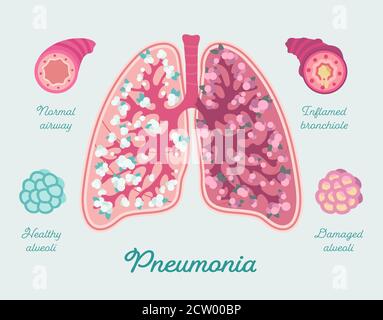 Pneumonia in human lungs. Inflammation lungs - including due to COVID-19. Respiratory diseases Stock Vector