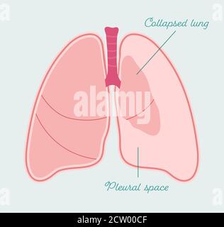 Pneumothorax of human lungs. Collapsed lung - vector anatomical scheme Stock Vector