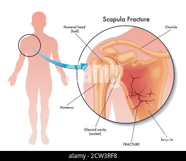 Medical illustration of a scapula fracture and its location in the human body, with annotations. Stock Vector