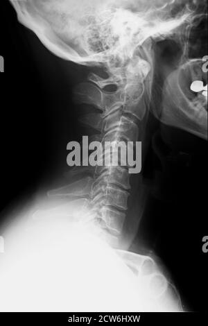 neck x-ray of cervical vertebrae, lateral view, 40 year old male ...